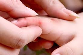 Hơn 770 ca mắc bệnh tay chân miệng