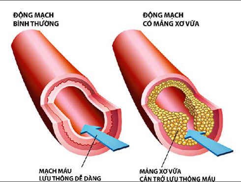 Triglyceride máu - những điều cần biết
