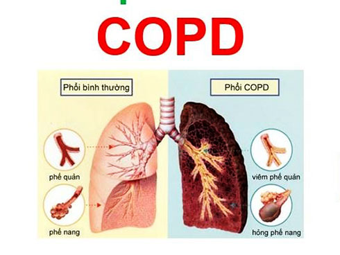 Hình ảnh tuyên truyền trực quan về phòng chống COPD.