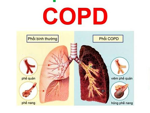Những lưu ý về bệnh COPD