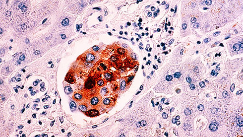  Hình ảnh về tế bào ung thư vú di căn tới gan. 