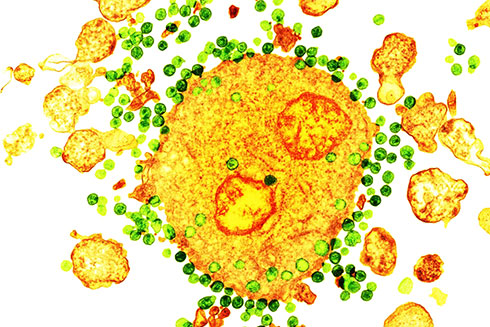 Nhà khoa học công bố bệnh nhân thứ hai trên thế giới được chữa khỏi HIV