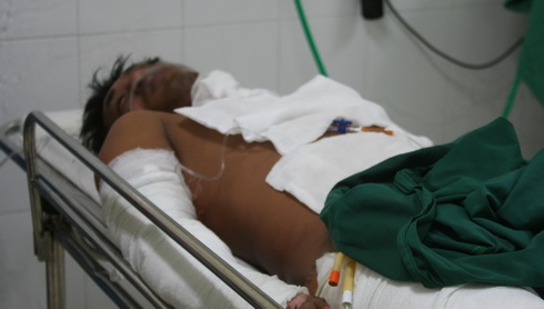 5 người nhập viện do bị bỏng xăng