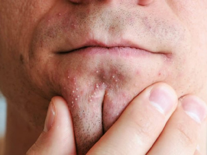 Cách phân biệt và điều trị hiệu quả 4 loại mụn phổ biến