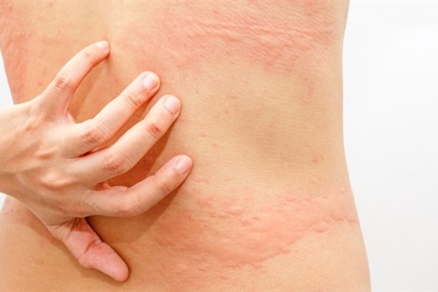 Những bệnh về da &quot;khó chịu&quot; ở nam giới