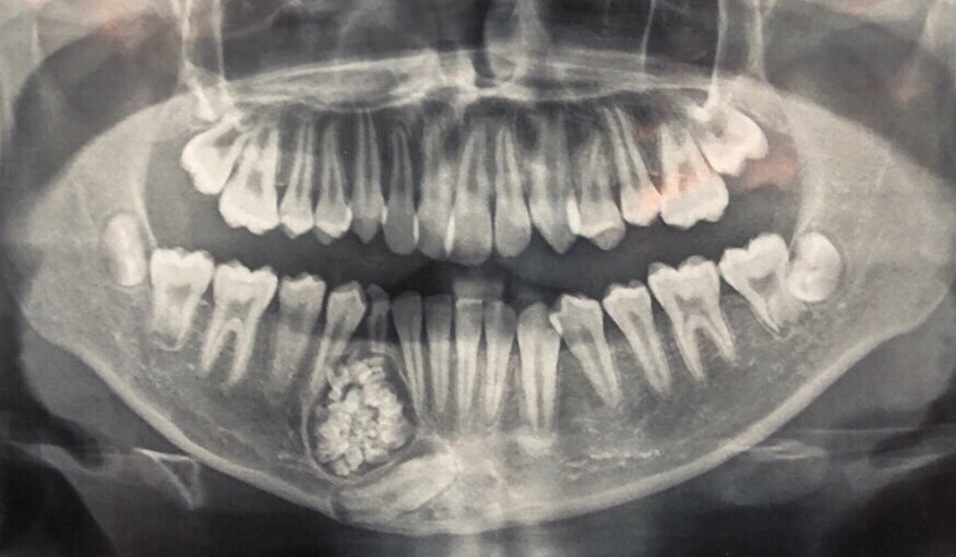  Khối U răng được phát hiện qua chụp X-quang 