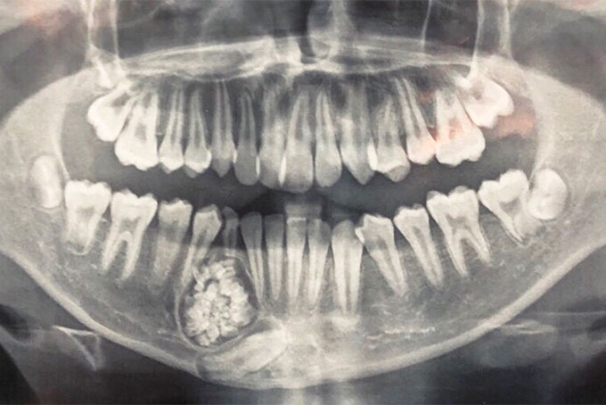 Khối u răng của bệnh nhân qua phim X-quang.
