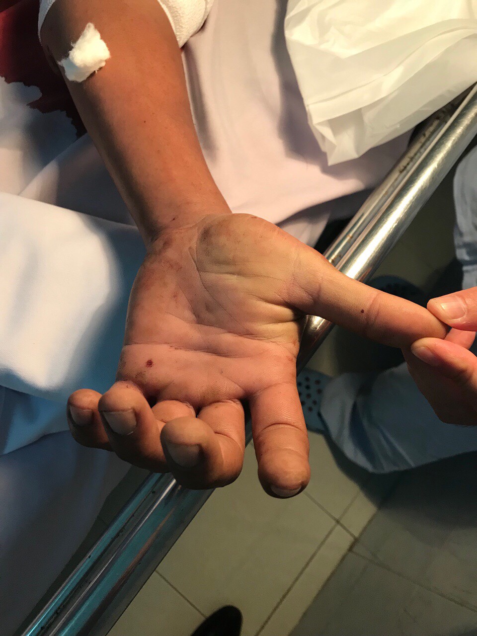 Nối thành công ca đứt gần hết cánh tay