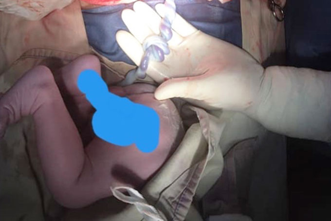 Cứu sống bé trai có nút thắt đôi ở dây rốn