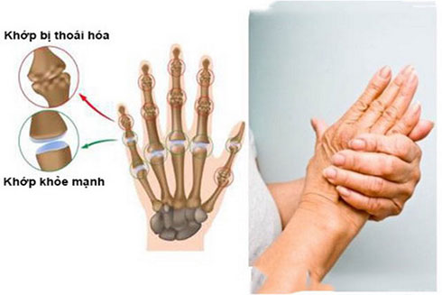 Người cao tuổi thường mắc các bệnh về xương khớp, trong đó bệnh thoái hóa khớp bàn tay là hay gặp nhất.