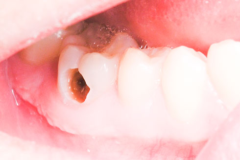 Dự phòng bệnh sâu răng ở trẻ em - Báo Khánh Hòa điện tử