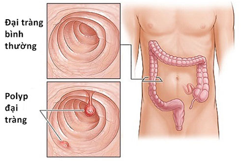 Polyp đại tràng là một nguyên nhân gây táo bón kéo dài.