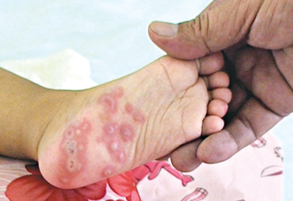 Tích cực phòng, chống bệnh tay chân miệng