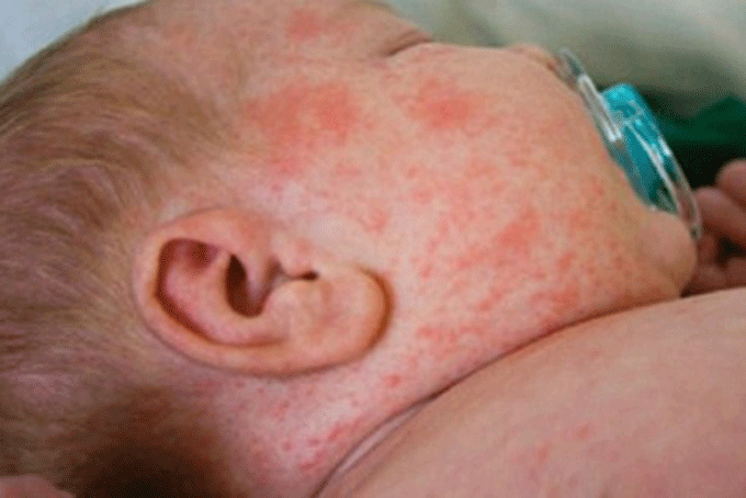 Dịch sởi có nguy cơ đe dọa các nước Nam Thái Bình Dương