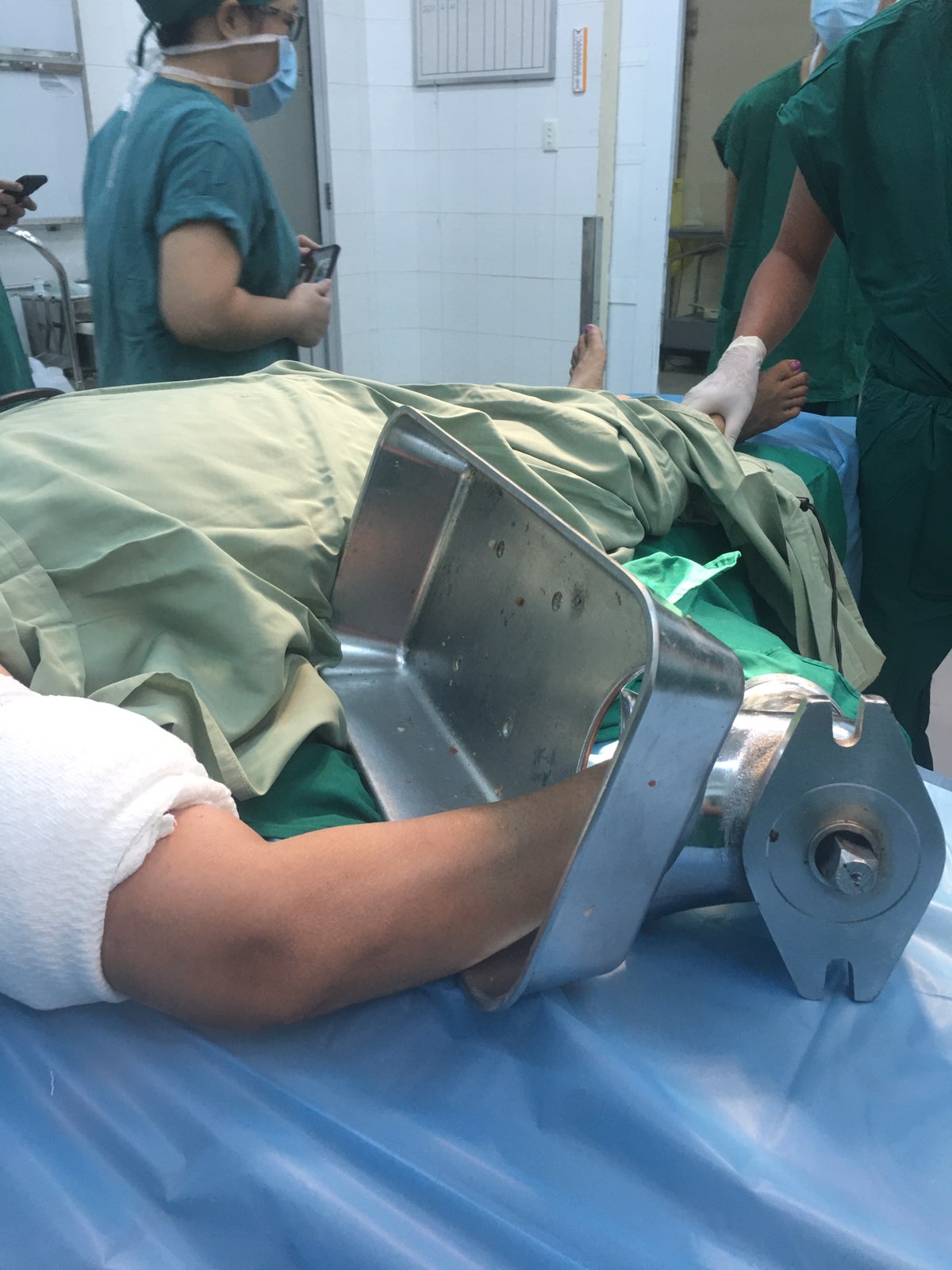 Bất cẩn trong lúc xay cá bị máy cuốn gần hết bàn tay