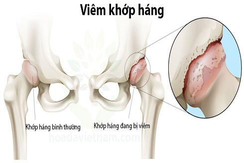 Khớp háng bị viêm - Một nguyên nhân gây đau.