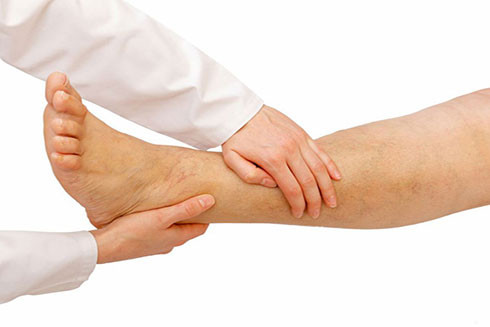 Một số cơn đau chân có thể là dấu hiệu của tình trạng nghiêm trọng, có thể đe dọa tính mạng Ảnh minh họa: Shutterstock
