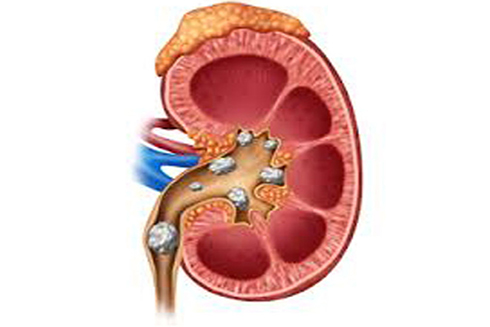 Những cách phòng ngừa sỏi thận bạn nên biết