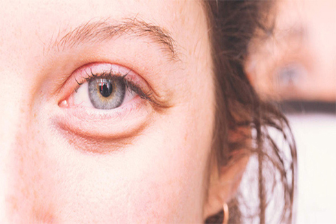 Bạn có bọng mắt có thể do thiếu ngủ hoặc mắc bệnh suy giáp, dị ứng. Ảnh: Draxe