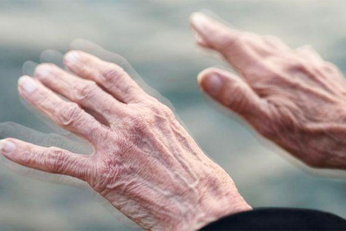 Hy vọng mới cho các bệnh nhân Parkinson