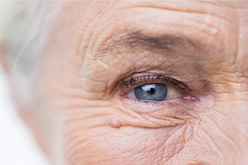 Đục thủy tinh thể là một trong những rối loạn về mắt phổ biến nhất ở người trên 40 tuổi. ẢNH MINH HỌA: SHUTTERSTOCK