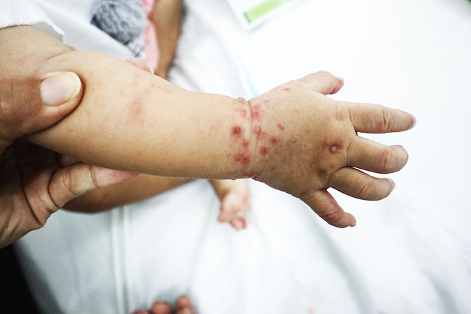 Những điều cần biết về bệnh tay chân miệng