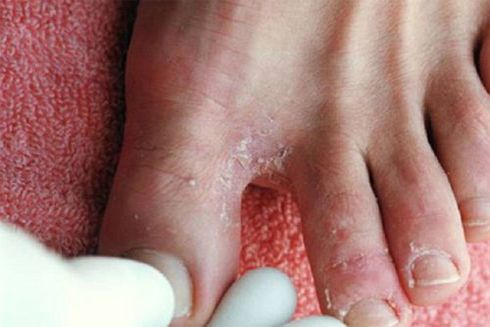 5 bệnh về da thường gặp sau mưa lũ