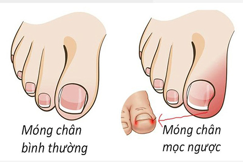 Lỗi sai khi cắt móng tay dễ gây viêm nhiễm đau đớn