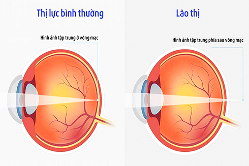 Người cao tuổi cần đề phòng bệnh mắt