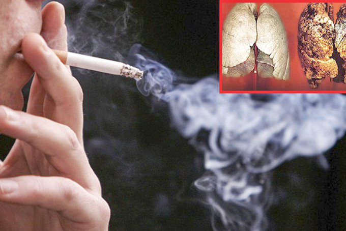 Hút thuốc lá gây ung thư phổi.