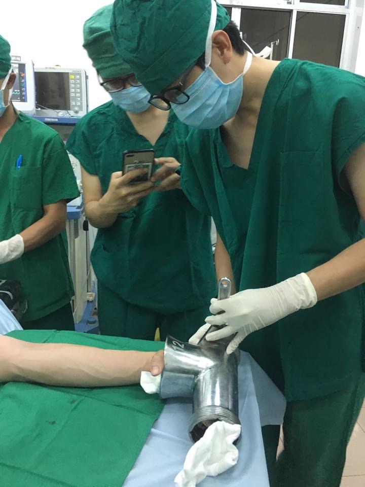 Cắt bỏ bàn tay do tai nạn lao động