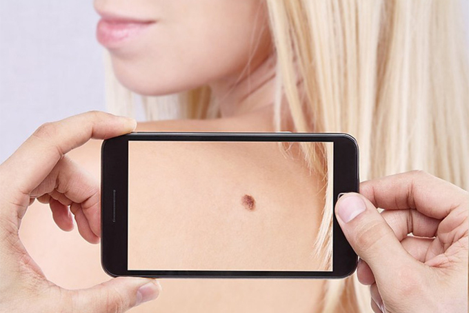 Nga phát triển ứng dụng giúp phát hiện ung thư da