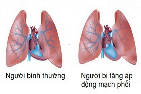 Nếu không được phát hiện và điều trị kịp thời, tăng áp động mạch phổi sẽ để lại những biến chứng nguy hiểm.