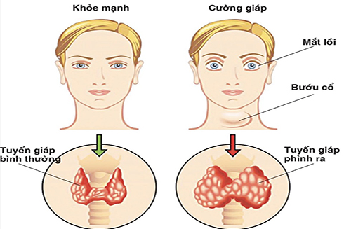 7 dấu hiệu cho thấy cơ thể bạn đang thiếu i-ốt