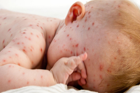 5 bệnh nguy hiểm mà trẻ thường mắc vào mùa hè