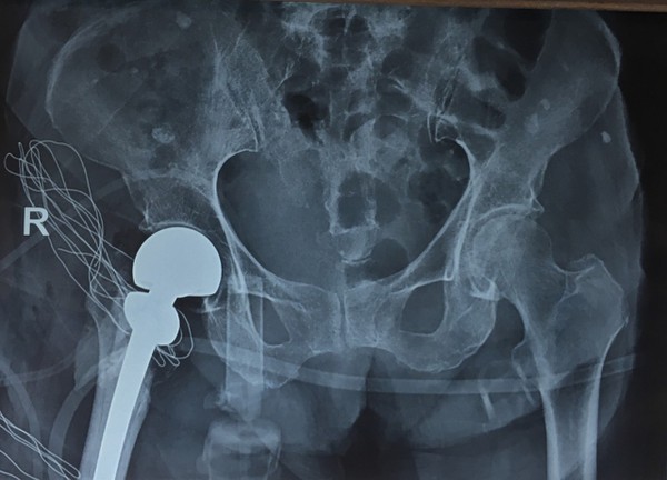 Bệnh viện Đa khoa tỉnh Khánh Hòa thay khớp háng thành công cho cụ bà 101 tuổi