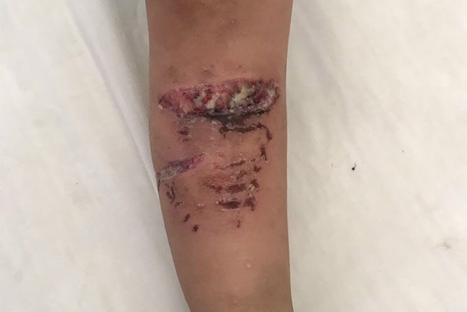 Bệnh viện Đa khoa tỉnh Khánh Hòa: Tiếp nhận một bệnh nhi bị chó Pitbull cắn