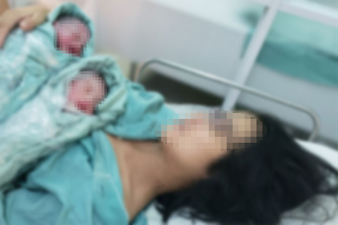 Cứu sống song thai tránh sinh non nhờ khâu cổ tử cung cấp cứu