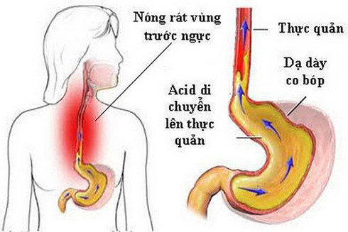 Axit trào ngược lên dạ dày gây ợ chua.