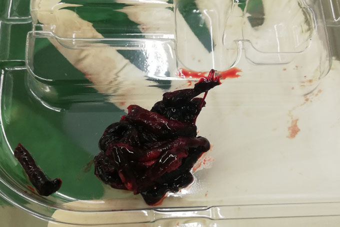 Cứu sống bệnh nhân tắc động mạch cánh tay trái do cục máu đông