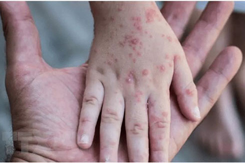 Tổ chức Y tế Thế giới ra khuyến cáo về bệnh đậu mùa khỉ