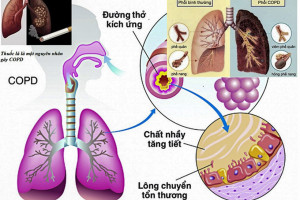 Cai thuốc lá và tiêm vắc xin phòng Covid-19: Giúp bảo vệ người bệnh phổi tắc nghẽn mạn tính