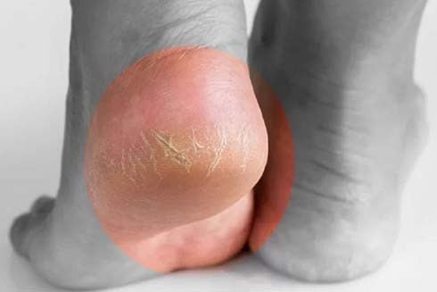 Thiếu vitamin C, B3 và E có thể khiến da bị khô và nứt nẻ gót chân. Ảnh: SHUTTERSTOCK