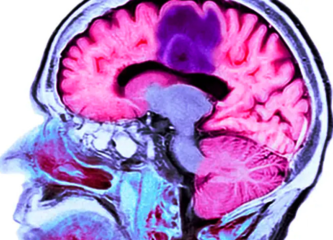  Hình ảnh não của một người bệnh có khối u nguyên bào thần kinh. 