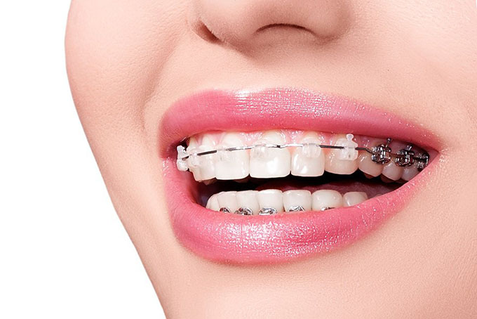 Top 5 địa chỉ nha khoa niềng răng uy tín nhất Nha Trang