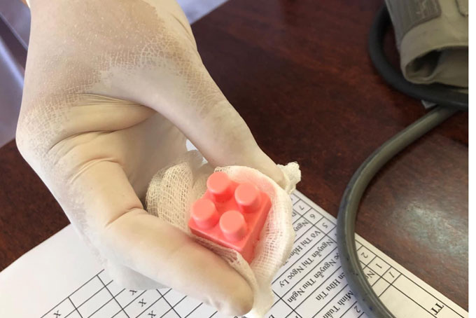 Cấp cứu gắp lấy dị vật thành công cho trẻ  9 tháng tuổi