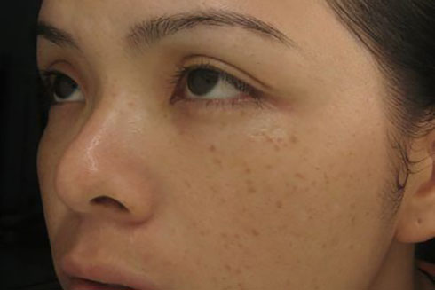 Lý do đốm nâu xuất hiện trên da