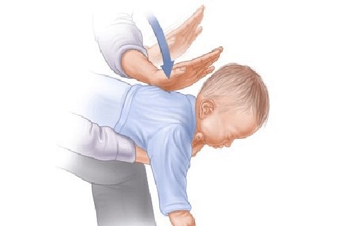 Cách sơ cứu khi trẻ sặc sữa