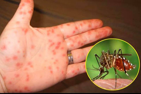 Số ca mắc sốt xuất huyết tăng, Bộ Y tế yêu cầu địa phương chủ động phòng chống